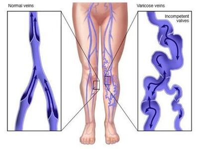 Neoveris prevén as deformidades venosas